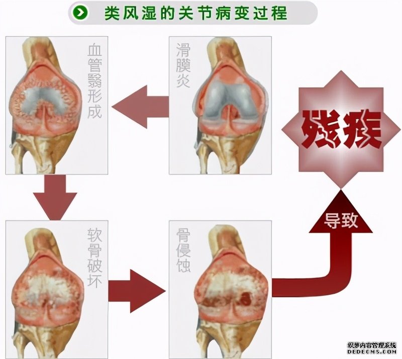 這些病癥你中了幾項？超過4項患類風濕性關節(jié)炎的幾率極高