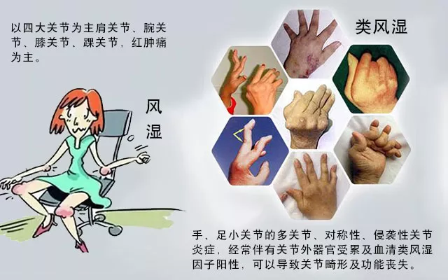這些病癥你中了幾項？超過4項患類風濕性關節(jié)炎的幾率極高
