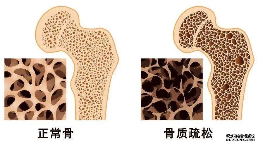 世界骨質(zhì)疏松日 | 預(yù)防“骨質(zhì)疏松”補(bǔ)鈣就可以了嗎？營養(yǎng)專家送你一份“護(hù)骨秘籍”