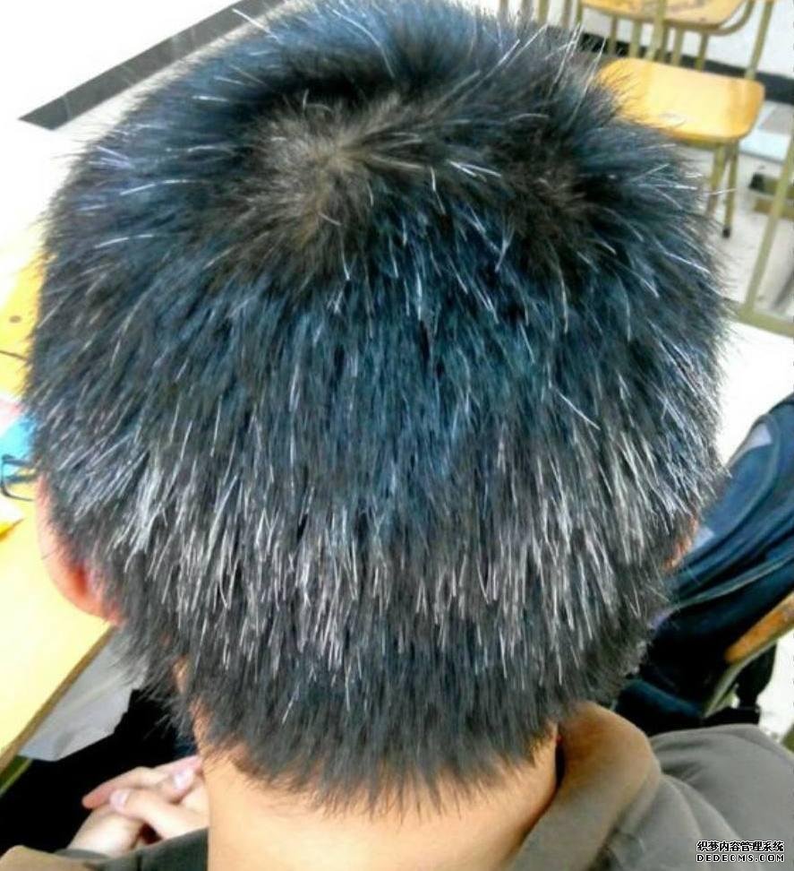 白發(fā)越長(zhǎng)越多，并非變老的信號(hào)，可能是身體缺乏這3種元素了
